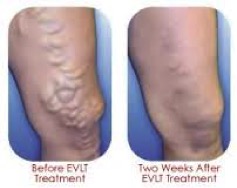 Endovenous Laser Ablation