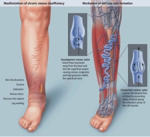 Venous-Insufficiency