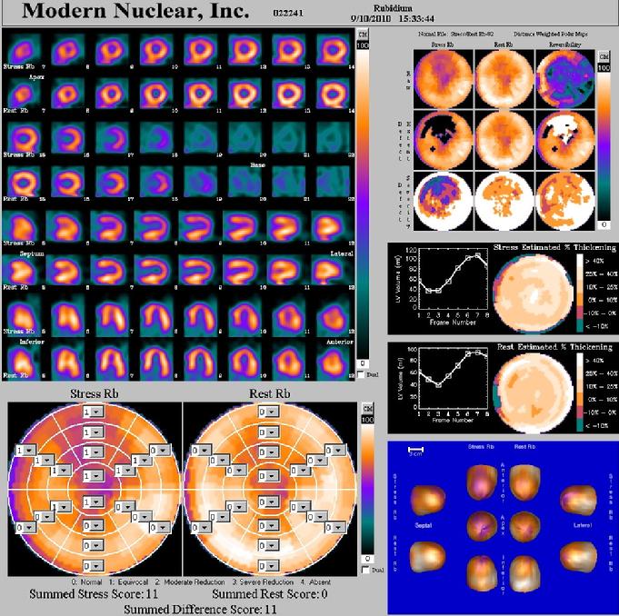 Cardiac-PET-Scan