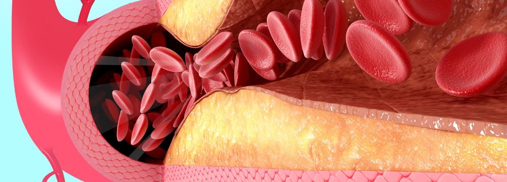 Medical illustration of plaque build up in artery demonstrates the damage caused by poor diet and lifestyle habits