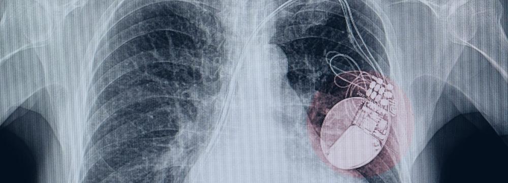 Xray shows a person's chest highlighting their pacemaker 